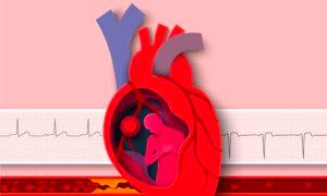 Motivation Improves Recovery From Heart Attacks: Study